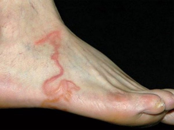 Cutaneous Larva Migrans